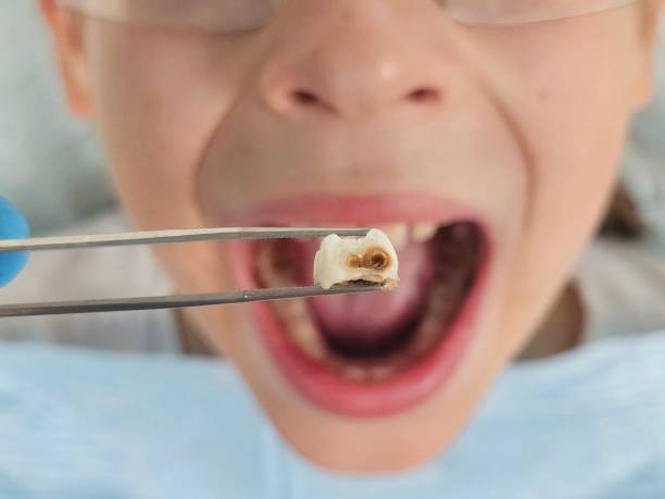 Best Emergency Wisdom Teeth Removal in Washington Park, IL